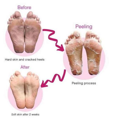 Bathefex SoftSole Express Exfoliating Foot Peel - Renew Your Feet - Image 3